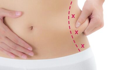 High-Definition Liposuction