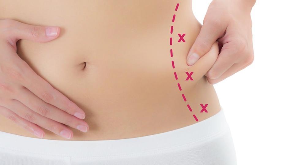 High-Definition Liposuction